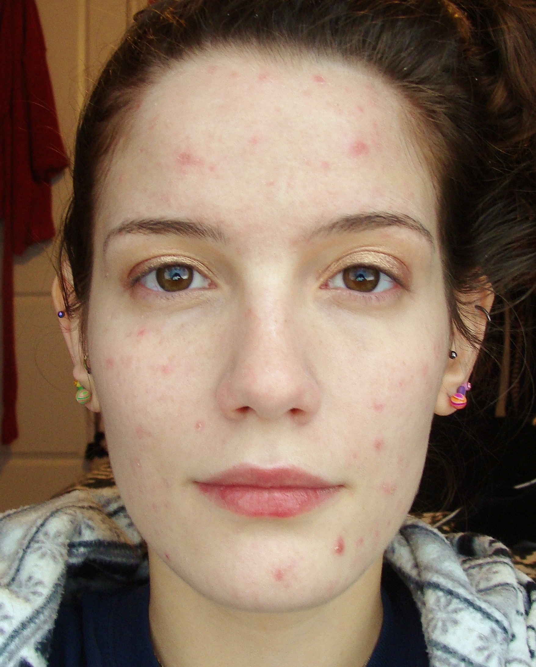 mild acne