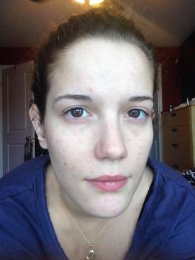 Day 16 - I'm liking the decrease in redness :)
